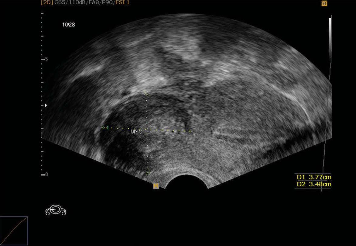 病例4 子宫浆膜下肌瘤